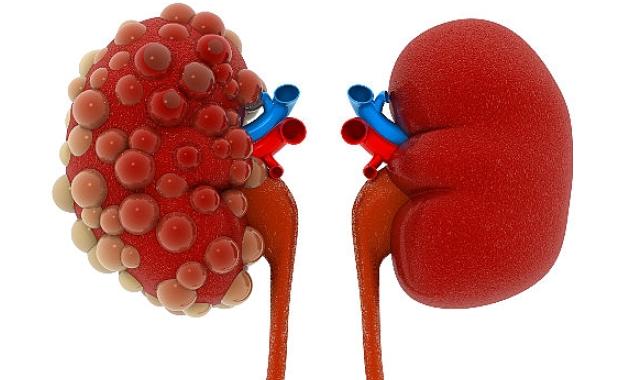 Polikistik böbrek hastalığı yavaş gelişir, her şey hızla değişir