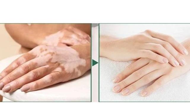 Dünyadaki birçok vitiligo hastası çareyi Bursa’da buluyor