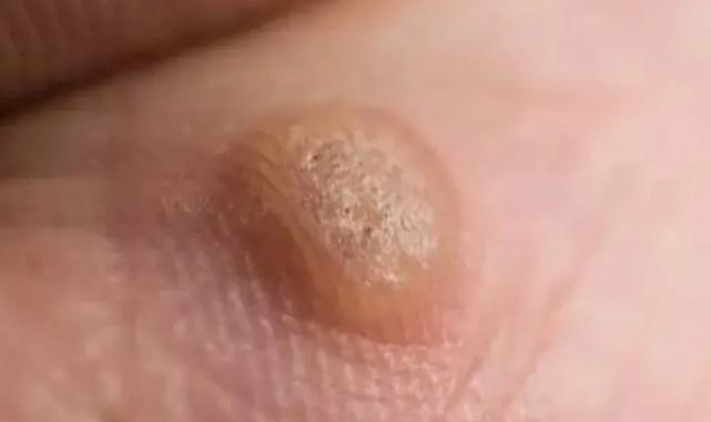 Ayakta ve genital bölgede çıkan siğile dikkat!