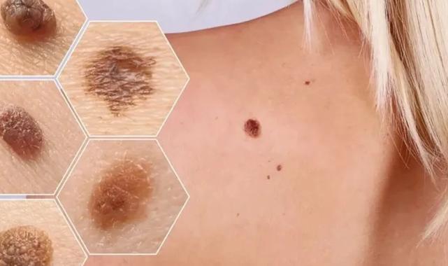 “Ben”im var diye sevinmeyin! Kanser olabilirsiniz