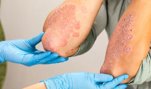 Bursa’da mantar uyarısı