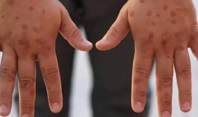 Maymun çiçeği virüsü hakkında bilinen yanlışlar