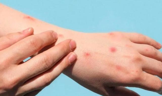 Maymun Çiçeği virüsü pandemi etkisi oluşturur mu? Korunmak için neler yapılmalı?