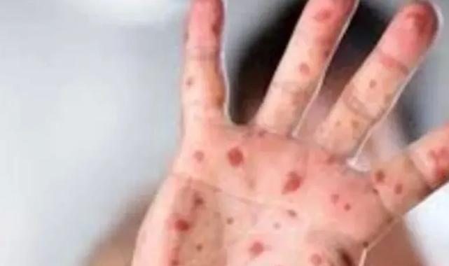 Maymun Çiçeği virüsüne karşı en dikkatli olması gereken sektör: Turizm