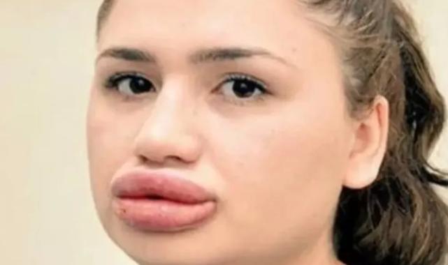 Merdiven altı botoks uygulamaları can alabilir