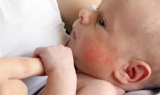 Alerjik bebeklerde emzirme düzeni nasıl olmalı?