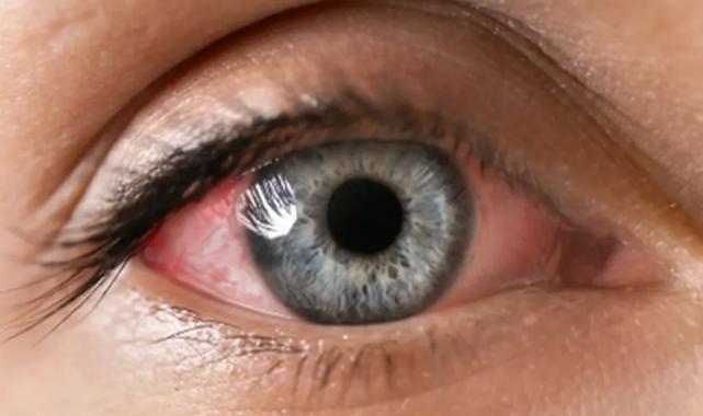 Göz enfeksiyonundan korunmanın 6 yolu