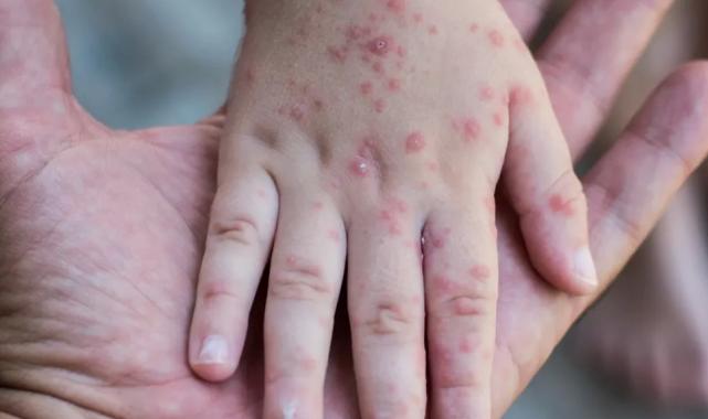 Okul sezonunda bulaşıcı enfeksiyonlara dikkat!