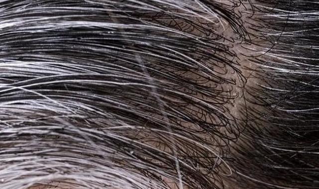 Saç neden beyazlar? İşte 6 nedeni!