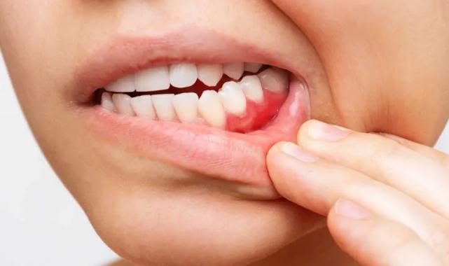 Dişeti hastalıkları kalp sağlığını tehdit ediyor