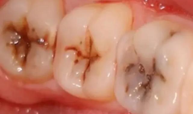 Kola en çok dişlere zarar veriyor