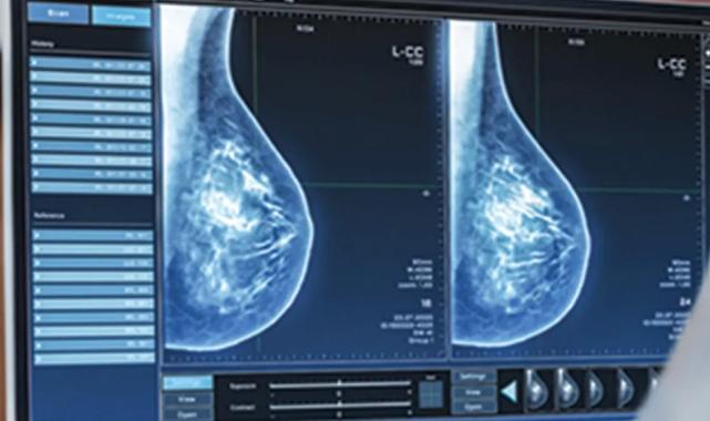“Mamografi erken tanı ve tedavi için önemli”