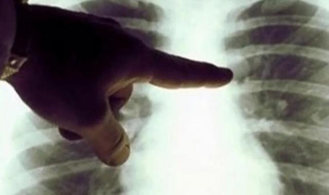 Akciğer kanserine yakalanmamak için bunlara dikkat edin!