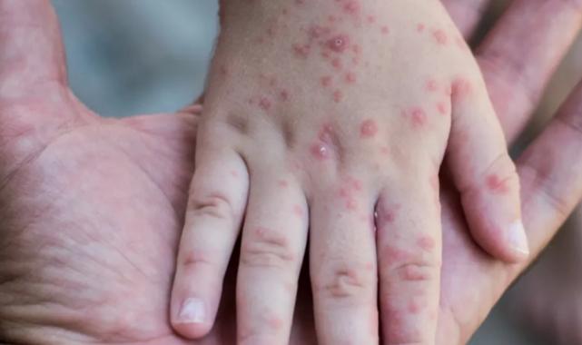 Küçük Ellerde Büyük Risk: El, Ayak, Ağız Hastalığına Dikkat!