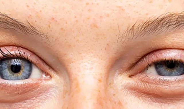 Göz kapak sarkması çocukları da etkiliyor!