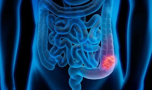 Kolon Kanseri Belirti Vermeden İlerleyebilir, Erken Teşhisle Sağlığınızı Koruyun