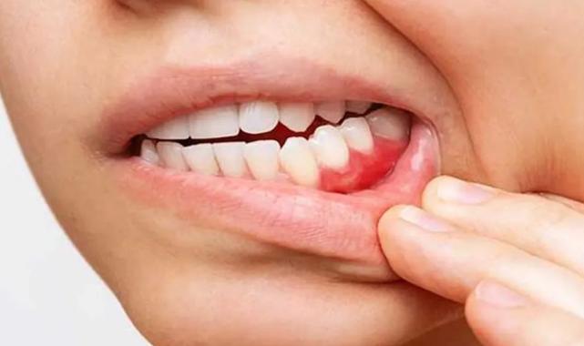 Diş eti çekilmesi diş kaybı ile sonuçlanabilir!