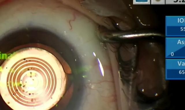 Canlı yayında göz ameliyatı yaptılar