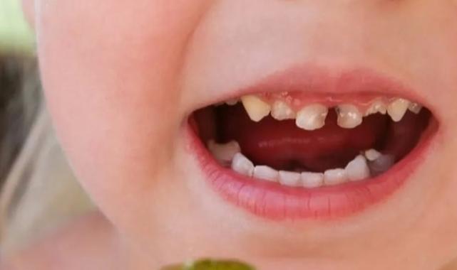 Okul çağındaki çocuklarda çürük riskine dikkat! Paketli gıdalar çocuk dişlerini vuruyor!