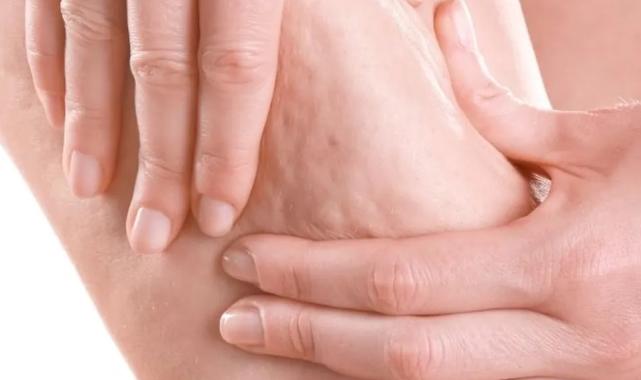 Prof. Dr. Karacalar’dan selülit uyarısı: Portakal kabuğu görüntüsü basit sorun değil!